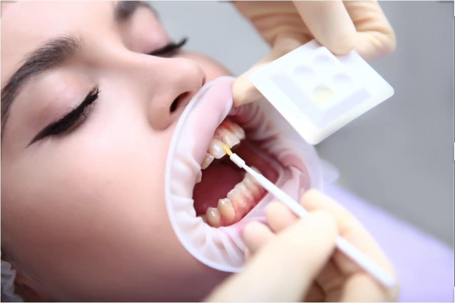 TRATAMIENTO PREVENCION DE CARIES