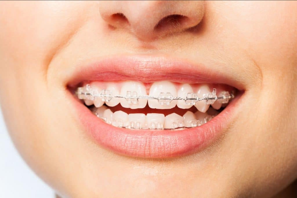 dientes torcidos: para qué sirven los brackets