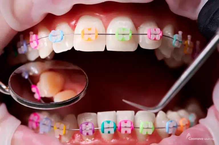 Todo lo que debes saber sobre los colores de brackets - Coomeva Salud Oral