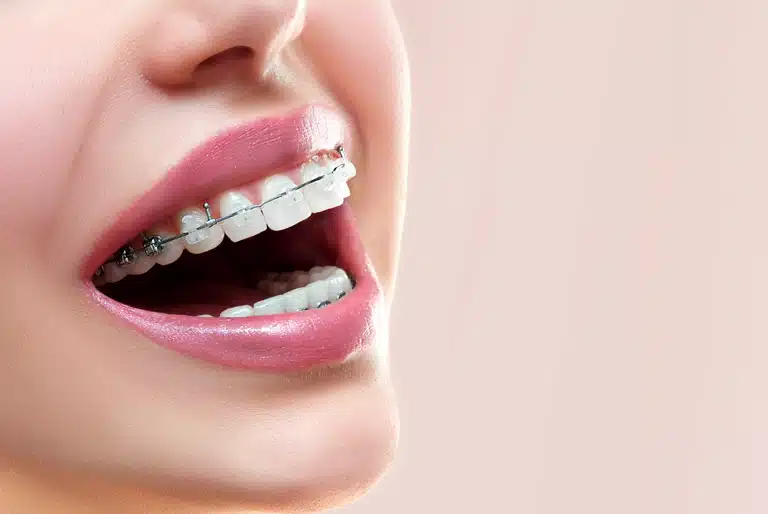 Descubre todo lo que debes saber sobre los brackets transparentes - Coomeva Salud Oral