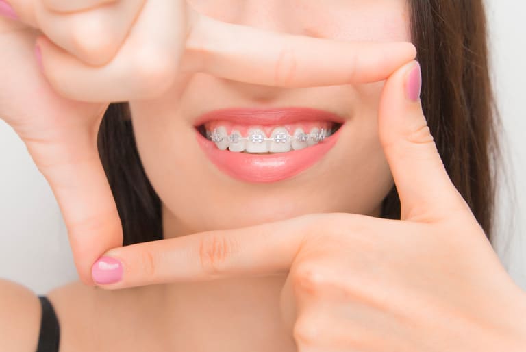 Aprende sobre el funcionamiento de los brackets - Coomeva Salud Oral