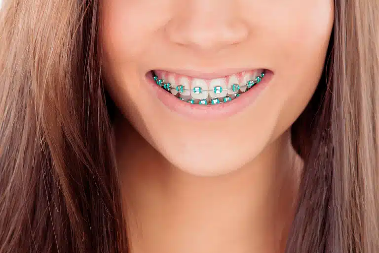 Dale un poco de color a tus ligas de brackets - Coomeva Salud Oral