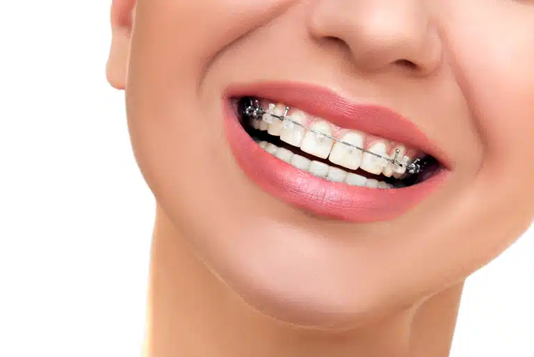 conoce los brackets estéticos o discretos - Coomeva Salud Oral