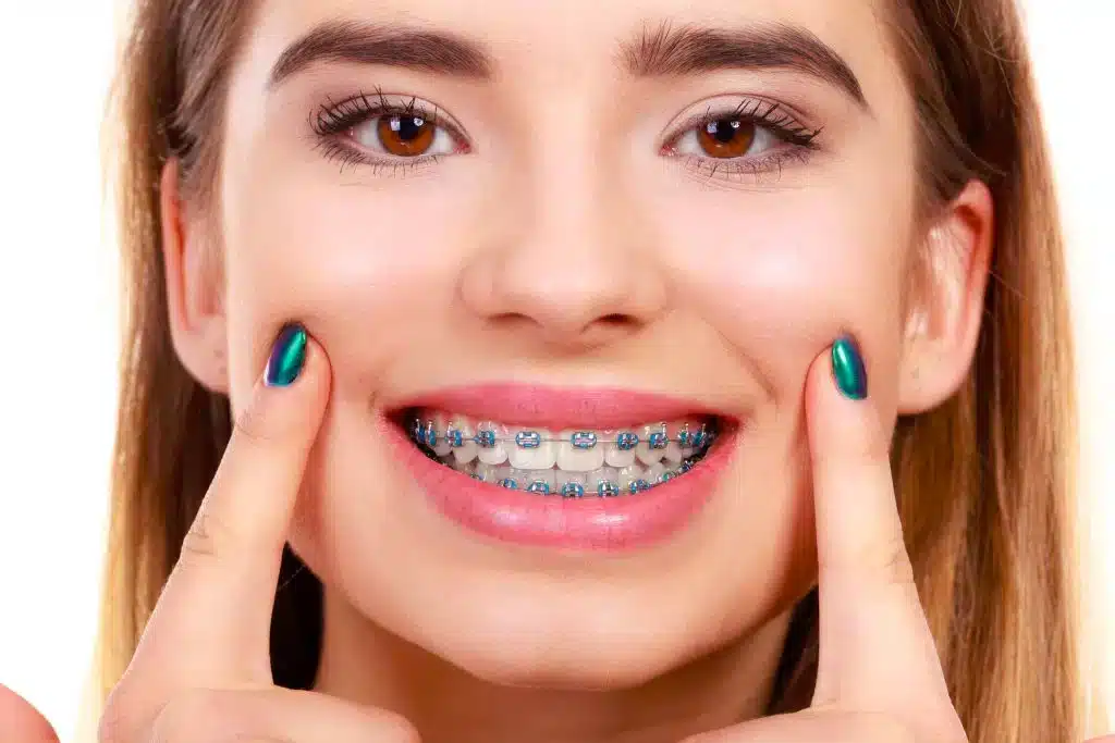 Los brackets de colores son una opción moderna