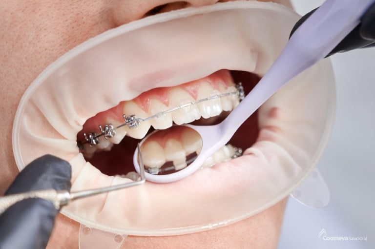 Existen diferentes tipos de brackets en ortodoncia