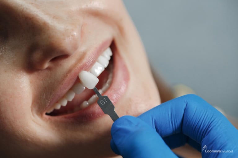 Los implantes dentales pueden reemplazar dientes pérdidos