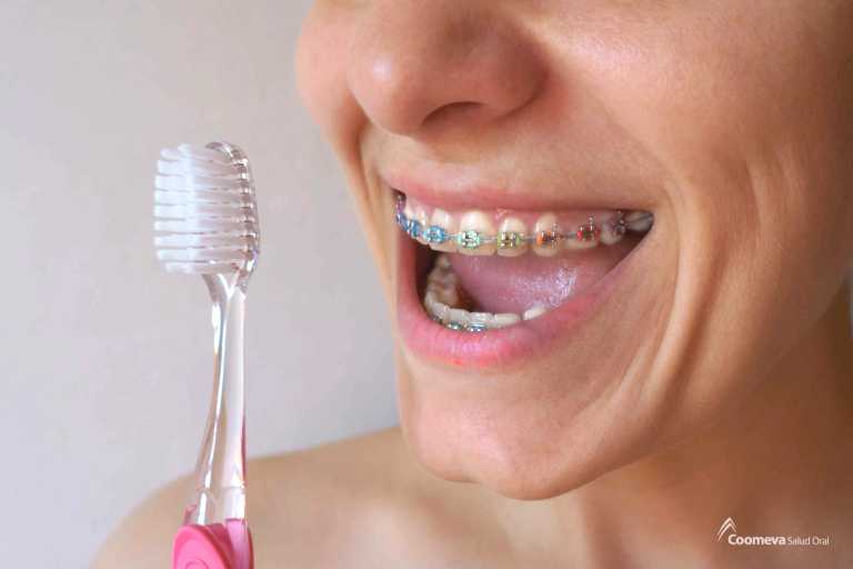 Por qué los colores de brackets son una gran opción