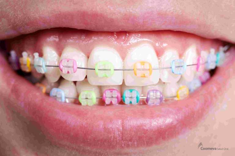 Colores de brackets para una sonrisa con estilo