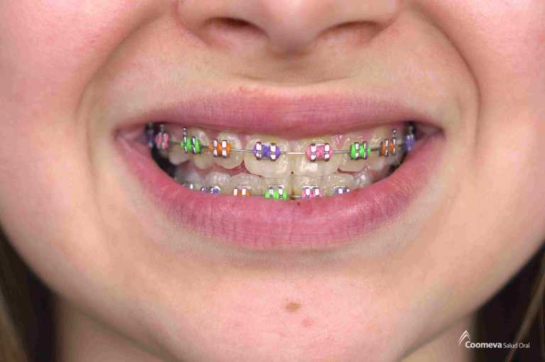 Empieza tu tratamiento de brackets de colores en Coomeva Salud Oral