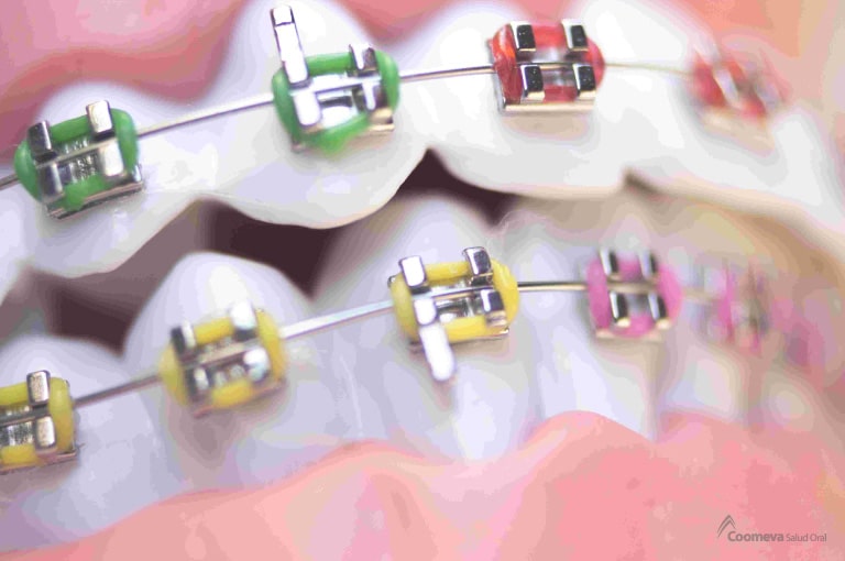 Cómo elegir los mejores colores de brackets